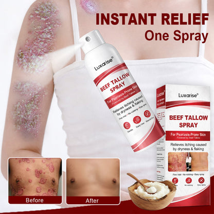 𝗟𝘂𝘅𝗮𝗿𝗶𝘀𝒆® 𝗕𝗲𝗲𝗳 𝗧𝗮𝗹𝗹𝗼𝘄 𝗦𝗽𝗿𝗮𝘆 𝗳𝗼𝗿 𝗜𝘁𝗰𝗵𝘆, 𝗙𝗹𝗮𝗸𝘆 𝗣𝘀𝗼𝗿𝗶𝗮𝘀𝗶𝘀 𝗦𝗸𝗶𝗻 💧