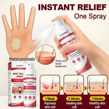 𝗟𝘂𝘅𝗮𝗿𝗶𝘀𝒆® 𝗕𝗲𝗲𝗳 𝗧𝗮𝗹𝗹𝗼𝘄 𝗦𝗽𝗿𝗮𝘆 𝗳𝗼𝗿 𝗜𝘁𝗰𝗵𝘆, 𝗙𝗹𝗮𝗸𝘆 𝗣𝘀𝗼𝗿𝗶𝗮𝘀𝗶𝘀 𝗦𝗸𝗶𝗻 💧