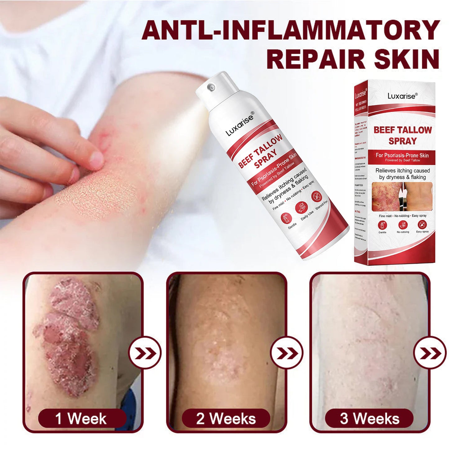 𝗟𝘂𝘅𝗮𝗿𝗶𝘀𝒆® 𝗕𝗲𝗲𝗳 𝗧𝗮𝗹𝗹𝗼𝘄 𝗦𝗽𝗿𝗮𝘆 𝗳𝗼𝗿 𝗜𝘁𝗰𝗵𝘆, 𝗙𝗹𝗮𝗸𝘆 𝗣𝘀𝗼𝗿𝗶𝗮𝘀𝗶𝘀 𝗦𝗸𝗶𝗻 💧