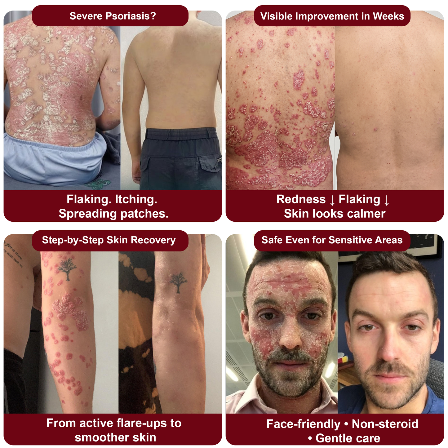 𝗟𝘂𝘅𝗮𝗿𝗶𝘀𝒆® 𝗕𝗲𝗲𝗳 𝗧𝗮𝗹𝗹𝗼𝘄 𝗦𝗽𝗿𝗮𝘆 𝗳𝗼𝗿 𝗜𝘁𝗰𝗵𝘆, 𝗙𝗹𝗮𝗸𝘆 𝗣𝘀𝗼𝗿𝗶𝗮𝘀𝗶𝘀 𝗦𝗸𝗶𝗻 ✨